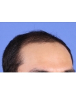 Before Hair Transplant&nbsp;Front